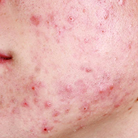 Acne cicatrici trattamento plasmage