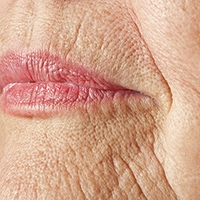 Rughe trattamento plasmage