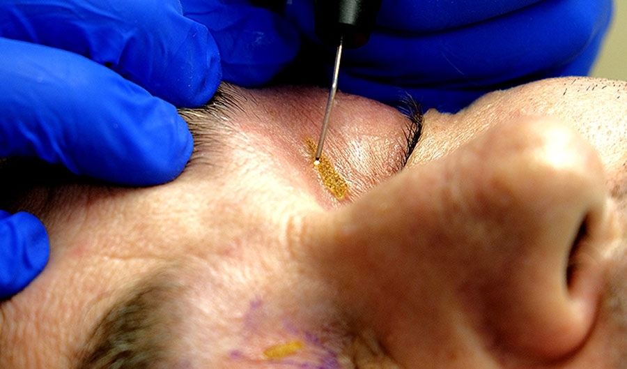 Trattamento Xanthelasma  - Studi